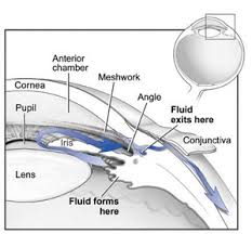 drenaje-acuoso-glaucoma