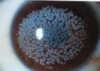 distrofia-macular-trasplante- córnea