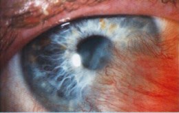 pterigion-severo-cirugía